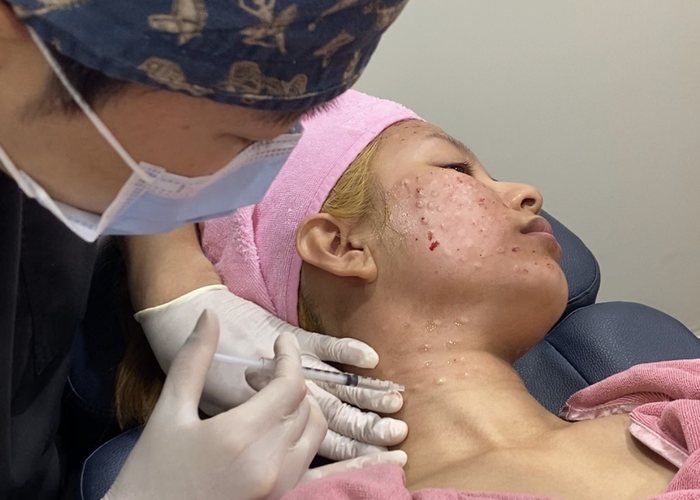 Bridge rhinoplasty